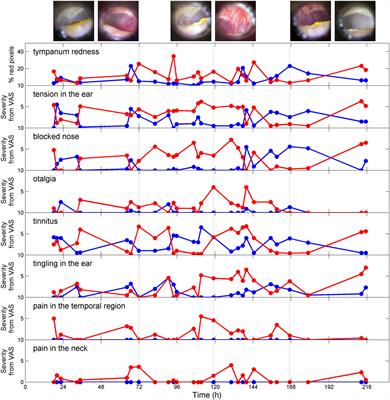 A Case of Acoustic Shock with Post-trauma Trigeminal-Autonomic Activation